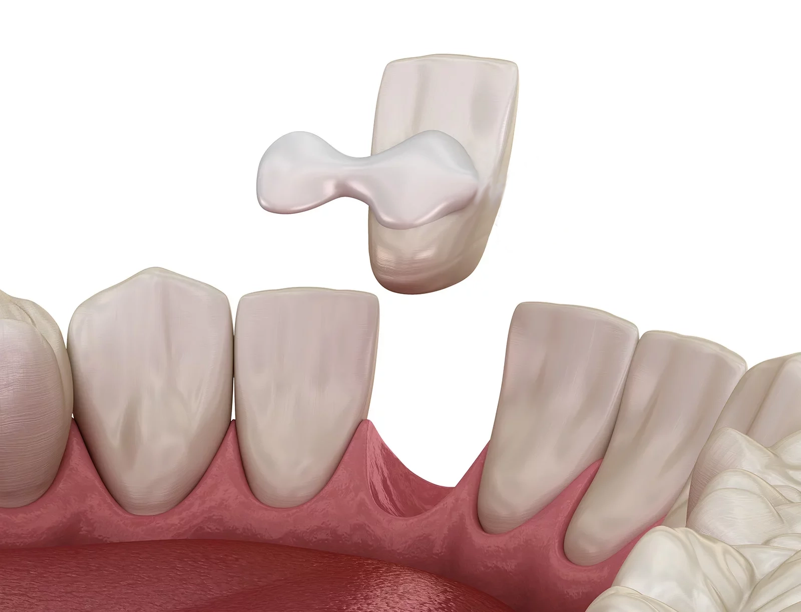 青山一丁目駅0分／南青山で「削らない接着性ブリッジ」｜新青山